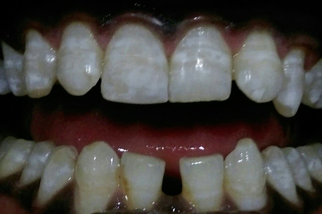 Child Dental care in kumbakonam